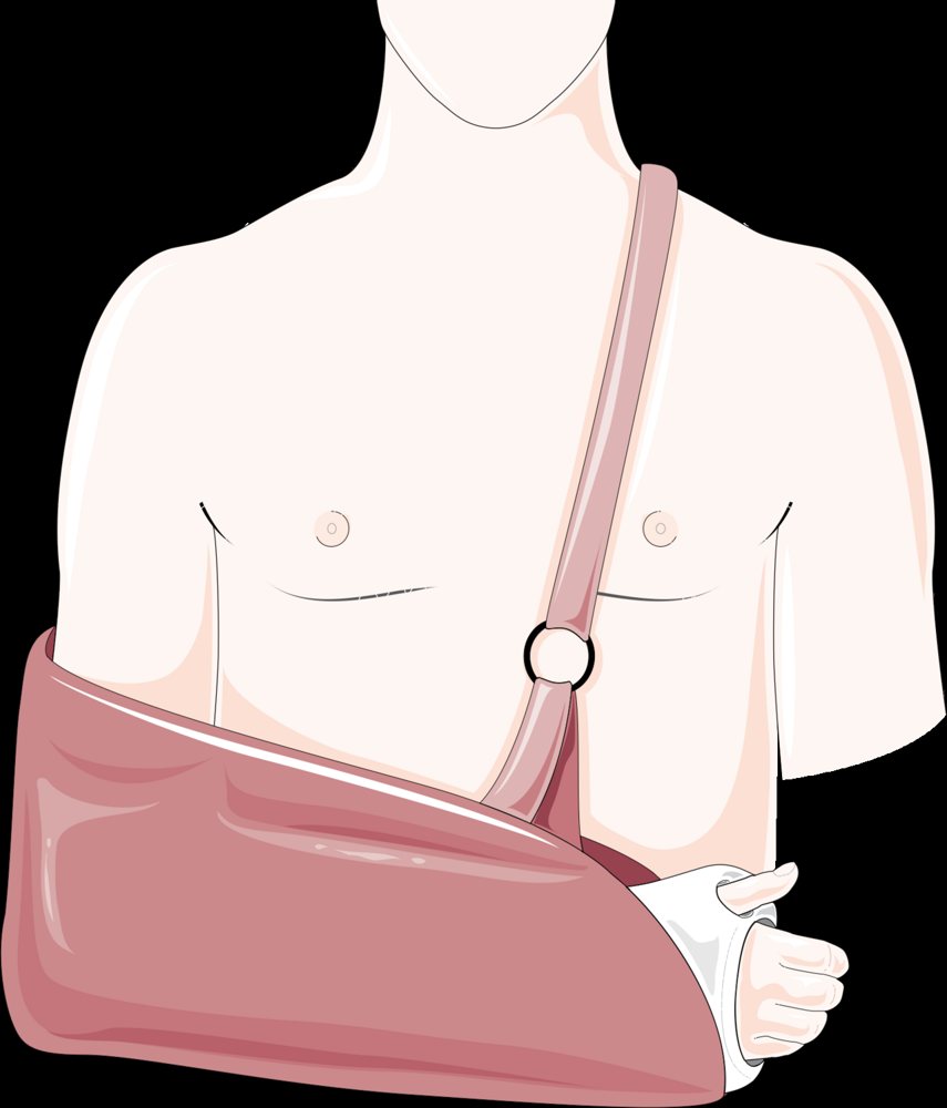 Illustration of a broad arm sling supporting the forearm across the chest, tied at the neck